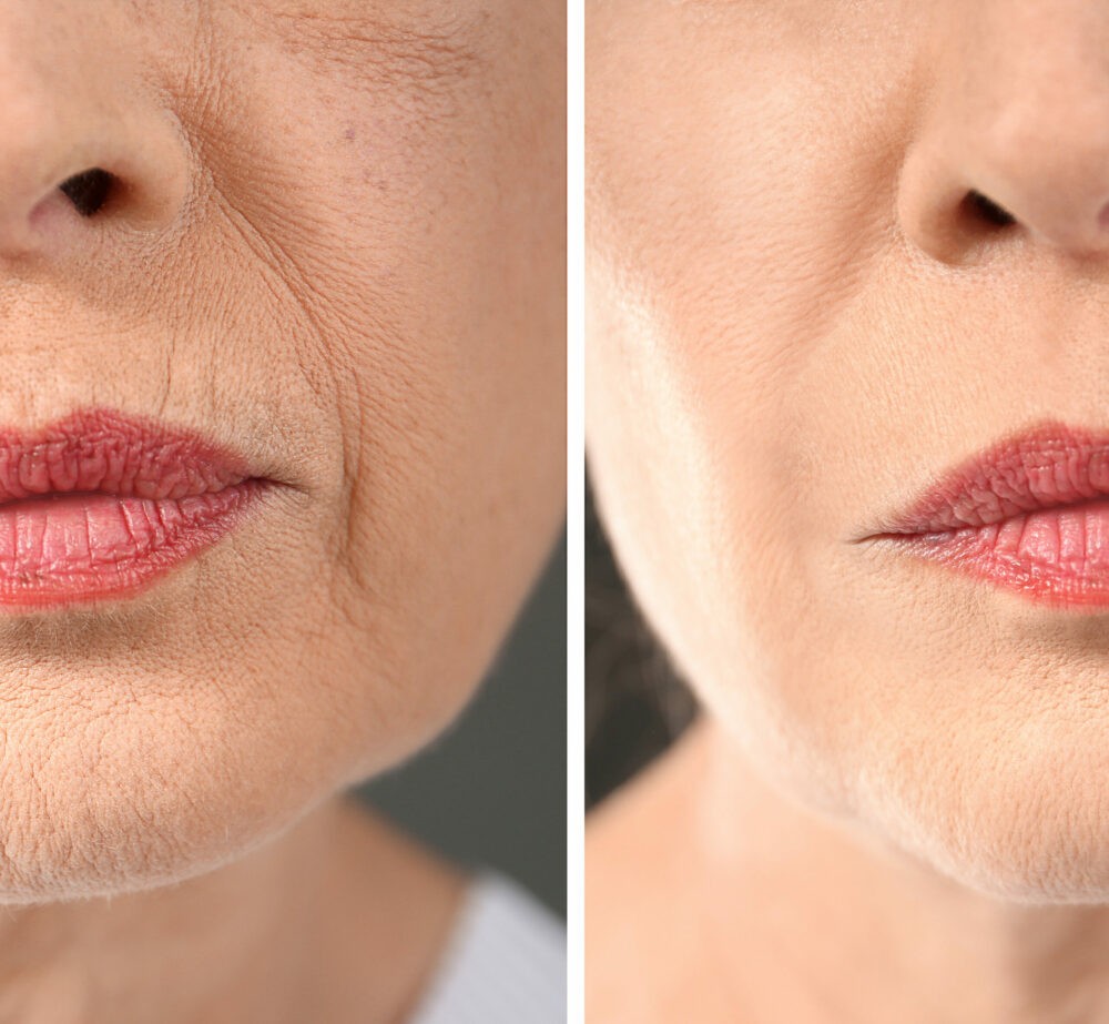 Senior woman before and after biorevitalization procedure, close Senior woman before and after biorevitalization procedure, closeup